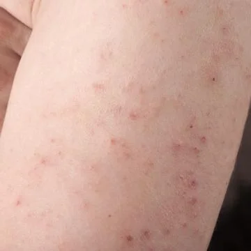 Allergic rash dermatitis Stock Photos