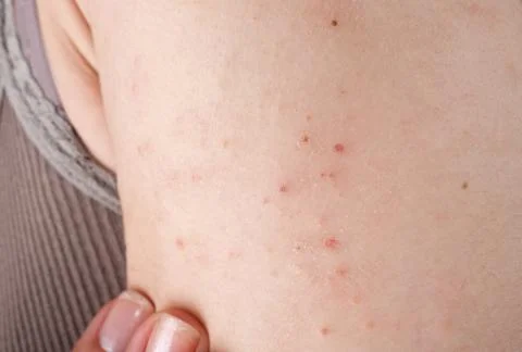 Allergic rash dermatitis Foto stock