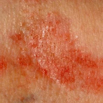  	allergic rash dermatitis skin of patient Stock Photos