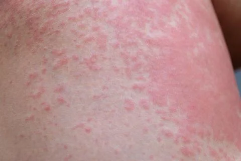Allergic rash on the leg. Photodermatitis. Allergy to the sun, ultraviolet. Stock Photos