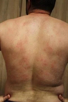 Allergic rash Stock Photos