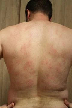 Allergic rash Stock Photos
