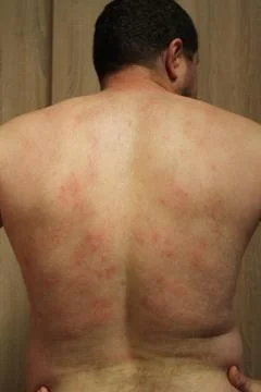 Allergic rash Stock Photos