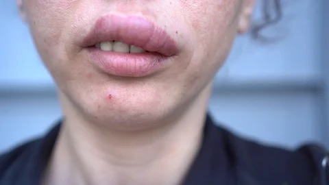 Allergic reaction to insect sting Stock Footage 107813686