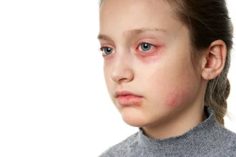 Allergic reaction, skin rash, close view portrait of a girl's face. Redness a Stock Photos