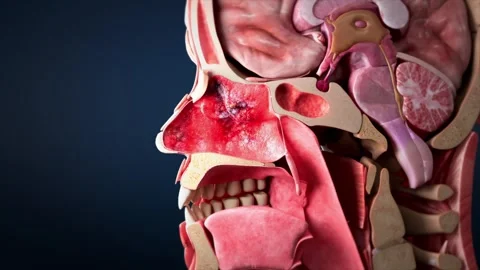Allergic rhinitis and viral ulcers cause red, swollen lesions Stockbeeldmateriaal 344955751