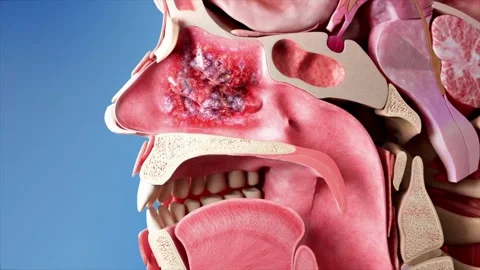 Allergic rhinitis, red and swollen nasal lesions and pus Vidéo 345107159