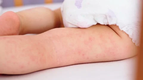 A photo of heat rash on the legs. Image of skin - Stock Photo