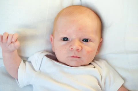 Allergies, atopic dermatitis on the face Stock Photos