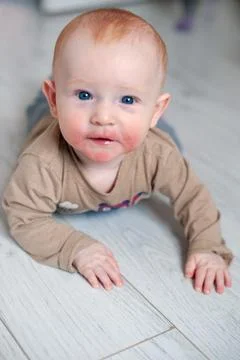 Allergies, atopic dermatitis on the face Stock Photos