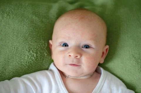 Allergies, atopic dermatitis on the face Stock Photos