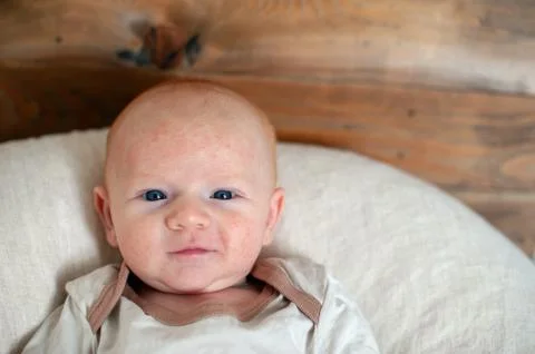 Allergies, atopic dermatitis on the face Stock Photos