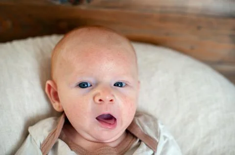Allergies, atopic dermatitis on the face Stock Photos
