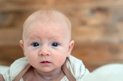 Allergies, atopic dermatitis on the face Stock Photos