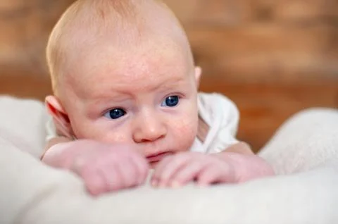 Allergies, atopic dermatitis on the face Stock Photos