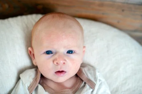 Allergies, atopic dermatitis on the face Stock Photos
