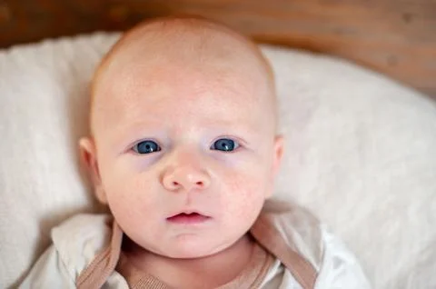 Allergies, atopic dermatitis on the face Stock Photos