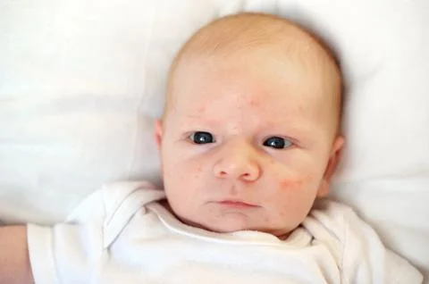 Allergies, atopic dermatitis on the face Stock Photos