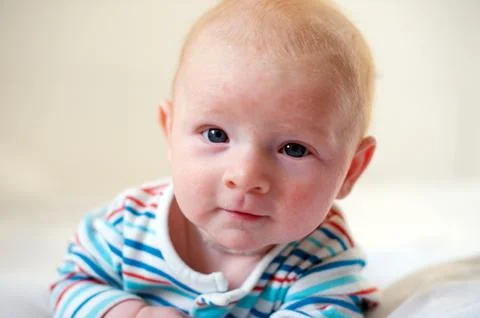 Allergies, atopic dermatitis Stock Photos
