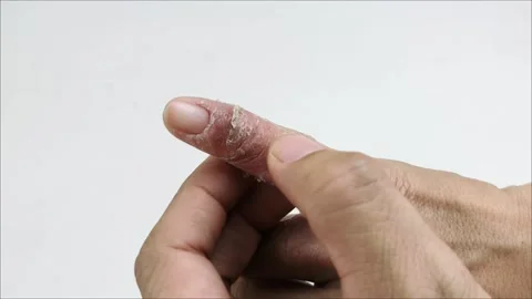 Allergies on the fingers and between the fingers that are scratched until t.. Stock Footage 330445766