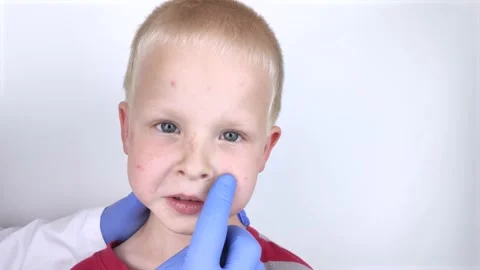 An allergist or dermatologist examines red spots on a child’s face. The boy suff Stock Footage 134704197