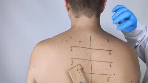 An allergist or dermatologist examines red spots on a man’s face. The male suffe Stock Footage 142731803