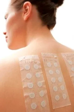 Allergy patch test Stock Photos