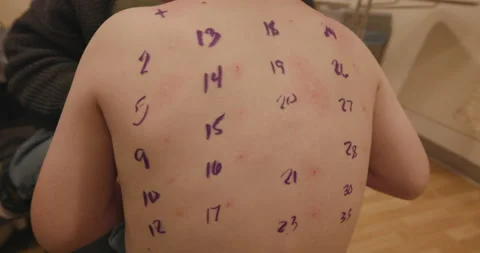 Allergy Testing on a Child Stock Footage 237842259