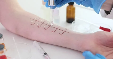 Allergy testing on the hand in a clinical setting with different solutions Stockbeeldmateriaal 284198925