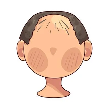 Alopecia illustration Stock Illustration