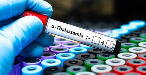 Alpha-thalassemia + Stock Photos