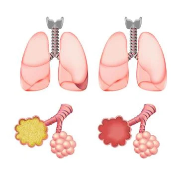 Alveoli in lungs set Stock Illustration