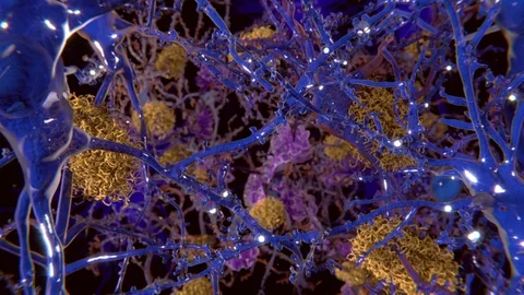 Alzheimers in the brain, animation Video stock 105241200