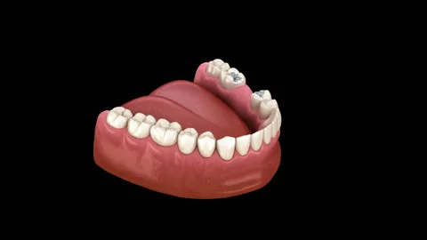 Amalgam removing and preparation for ceramic bridge placement Stock-Footage 124829218