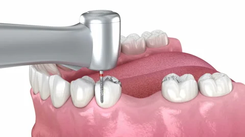 Amalgam removing and preparation for ceramic bridge placement Stock-Footage 129307702