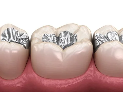 Amalgam restoration. Stock Illustration