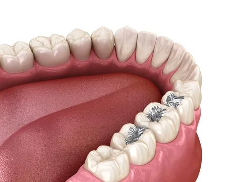 Amalgam restoration. Stock Illustration