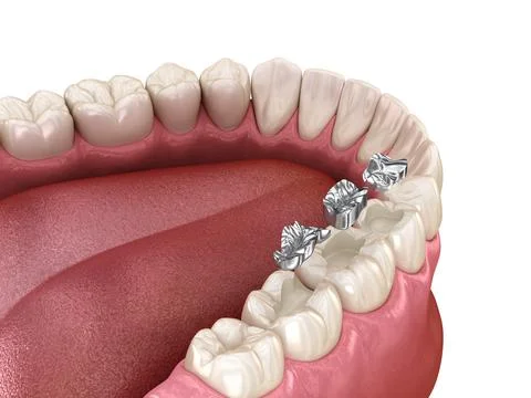 Amalgam restoration. Illustrazione stock
