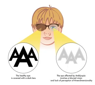 Amblyopia (lazy eye) Stock Illustration