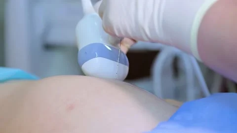 Amniocentesis. Amniotic fluid test. Stock Footage 237702258