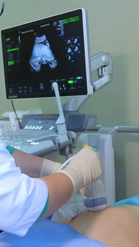 Amniocentesis. Amniotic fluid test. Video stock 269645769