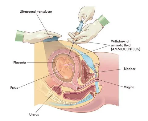 Amniocentesis Stock Illustration