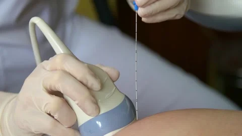 Amniotic fluid test. Amniocentesis. Stock Footage 269022854