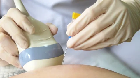 Amniotic fluid test. Amniocentesis. Stock Footage 269022872