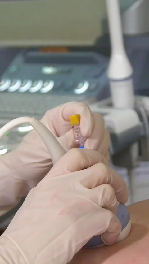 Amniotic fluid test. Amniocentesis. Vertical video. Stock Footage 269041373