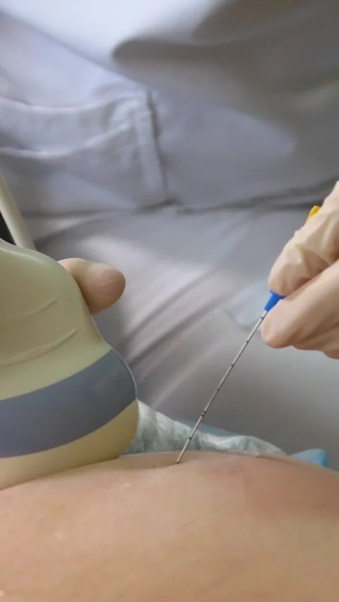 Amniotic fluid test. Amniocentesis. Vertical video. 库存影片 269041456