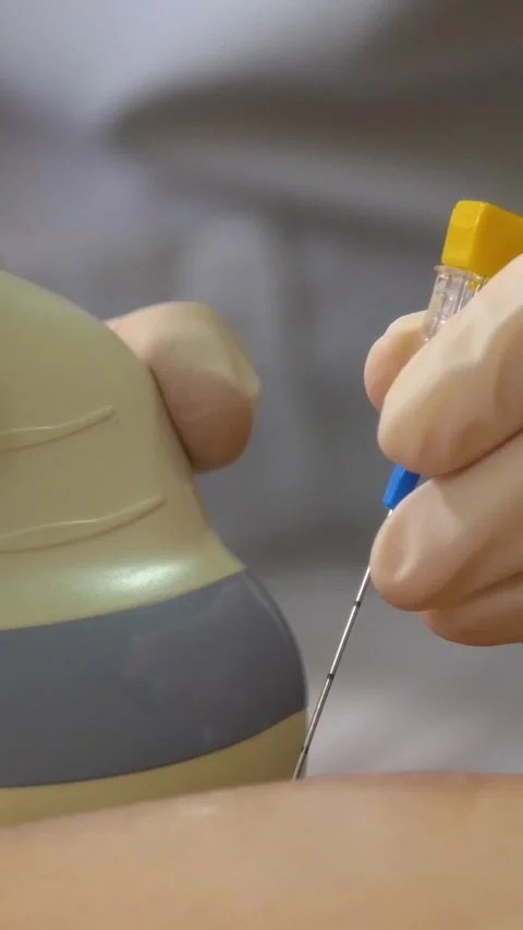 Amniotic fluid test. Amniocentesis. Vertical video. 库存影片 269041461