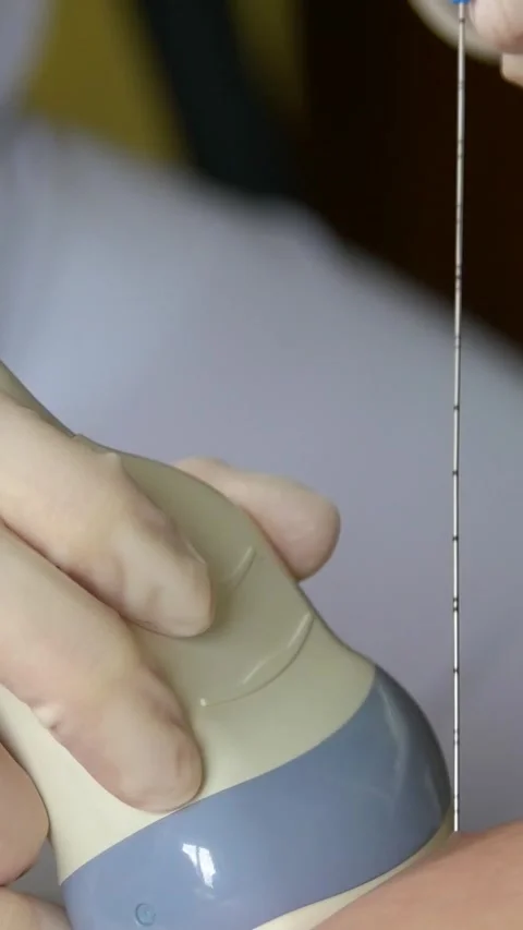 Amniotic fluid test. Amniocentesis. Vertical video. Stock Footage 269041489