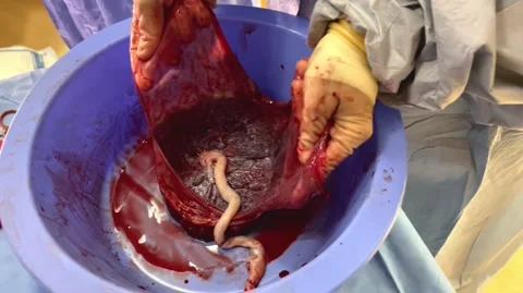 Amniotic sack. Placenta Stock Footage 159446891