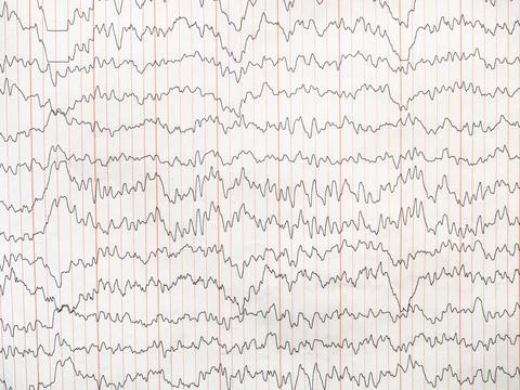 Amplitude-integrated electrical activity of brain Stock Photos